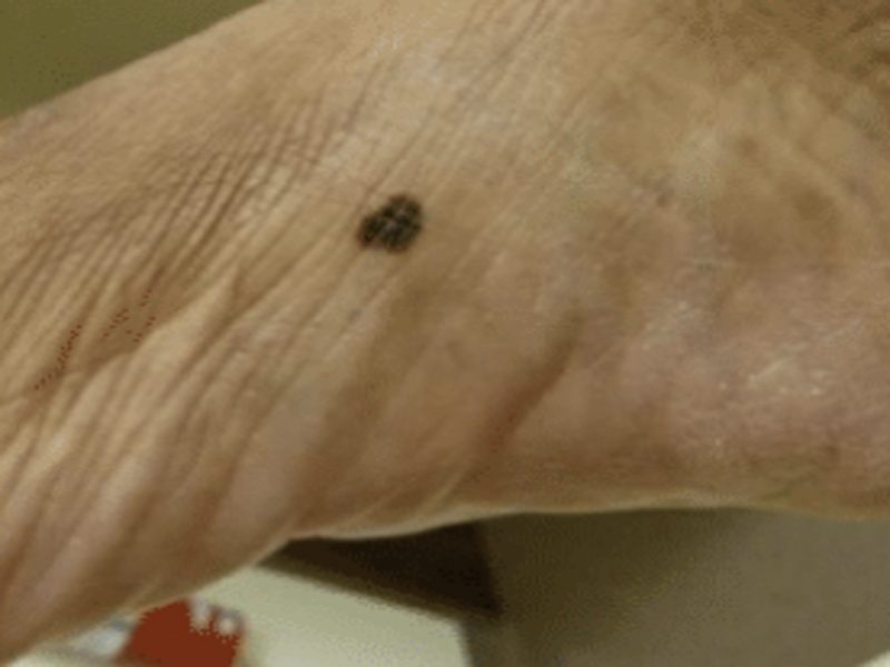 melanoma-on-top-of-foot
