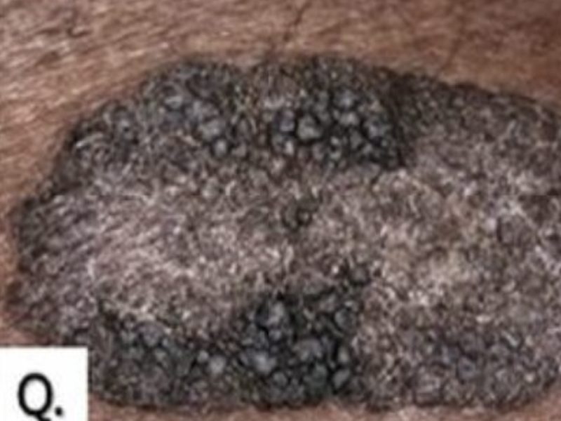 melanoma-skin-flattened
